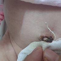 宝宝18天了，脐带还没脱落，今天消毒发现脐带是这样的，请教各位宝妈这样正常的？