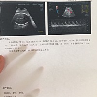 36周依然臀位，这一刀跑不了了😭