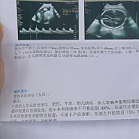 妈呀，股骨长才52，是不是腿特别短，我本人个子也不高，老天爷保佑千万不要遗传我的身高。😌