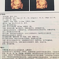 今天检查四维，医生说心室有强光斑，有没有宝妈是这种情况的，好担心哦