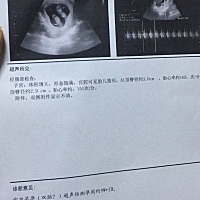 从来没有想到这种不可思议的事会发生在我的身上 双胎 我和老公都没有双胞胎的基因  今天去检查突然...