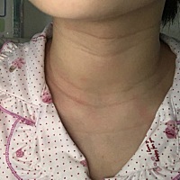 生完宝宝二十天颈纹一点都没淡  你们多久淡的？