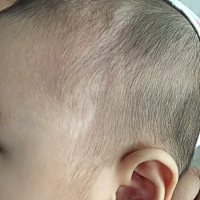 六个月宝宝头皮白斑，无皮屑，有谁知道这是怎么回事吗？去医院医生说要我观察，内心很着急，怕不会恢复...