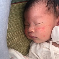 宝妈们宝宝脸上这是什么？是不是热的？婆婆说用奶洗洗脸，药膏不敢擦，现在宝宝才十几天。有没有遇到这...
