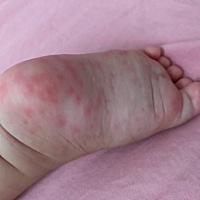 请问各位宝妈有没有宝宝类似的这样的，是什么情况，还拉肚子，屁股很红，昨天去医院检查医生就开了点拉...