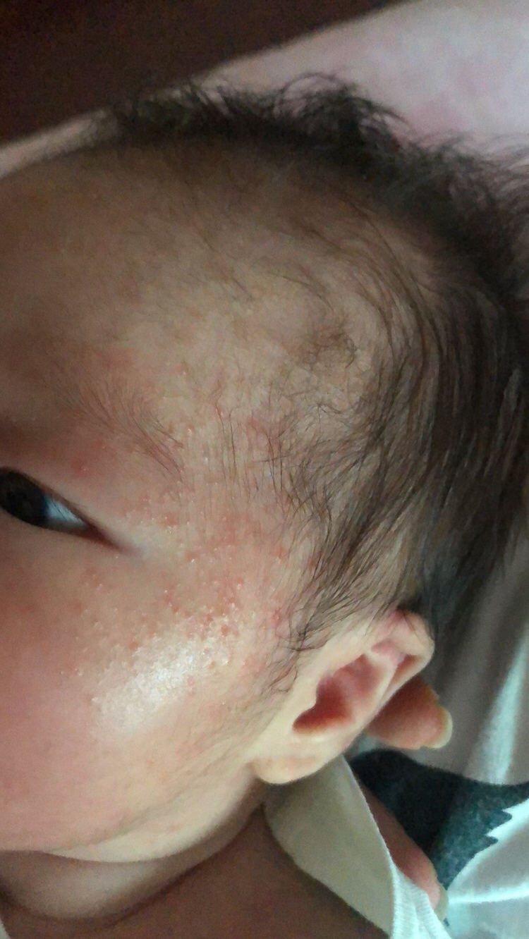 请问这是湿疹么？有越来越多的迹象，现在宝宝满脸都是，急求告知能用什么方法或者涂点什么？谢谢啦！