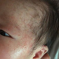 请问这是湿疹么？有越来越多的迹象，现在宝宝满脸都是，急求告知能用什么方法或者涂点什么？谢谢啦！