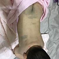 有人知道这是什么吗？开始是肚子有后来就全身都有了？还低烧，崩溃