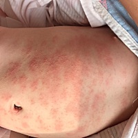 大家帮我看看这个是热痱还是麻诊或者湿疹呢？睡觉安静之后就没那么红，太多了，好可怕，打算晚点孩子她...