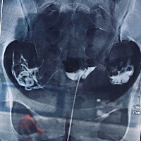 请问：有没有孕妈妈遇见过这种情况，医生说我子宫不是多完善，输卵管粘连，需要做微创手术。我自己很纠...