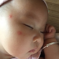 宝宝被蚊子咬了两个这么大的包   看着好心疼   请问各位宝妈给宝宝买的什么驱蚊水  最好还可以止痒消肿...
