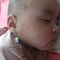 宝宝发烧反反复复烧了三天 第四天不烧了就在脖子上面上头上起了红点 这是正常的吗