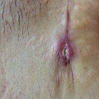 🈶刨腹产班个月了，刀口头上还有点破的里面肉也白白，怎么回事，该怎么处理呢