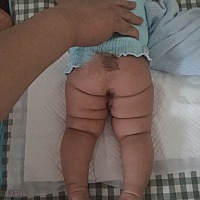 这不是髋关节脱位吧，两个大腿褶皱不对称，腿是一般长的，膝盖外展也正常，就是抱她时有时膝关节会响，...