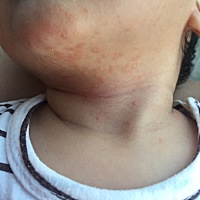 这什么东西，几天了，又不敢乱用东西，我也没吃什么热的东西，就下巴一点，我说去药店买药擦，我老公说...