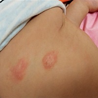 宝妈们，孩子身上有红片，摸上去有硬皮皮，抹了几天药，感觉没有好转，有类似经历的吗？？