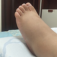 怀孕29周了，脚肿的吓死人，！！一按一个窝窝，可是检查血压血糖都正常，   怎么办啊各位孕妈妈！！...