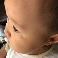 请问下谁知道这是怎么回事，宝宝昨天积食发烧，温度大概在37～38度之间，一直物理降温，今天早上起来脸...