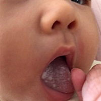 照片上宝宝舌头奶块似的小白点，是小儿鹅口疮，一般长在舌头和上颚上，我宝宝抹了一天半制霉素，用碳酸...
