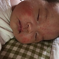 宝宝脸上这是湿疹吗，家里老人都说没关系，可是一开始就几个的长，现在越来越多，过几天就满月了，听说...