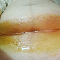 剖腹产第10天