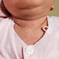 各位宝妈们，看我家宝宝脖子起的什么？给医生看过，医生说没事，但是还是有点不放心