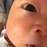 快满月了这两天宝宝起了一脸疙瘩，头发里面也有点，好着急