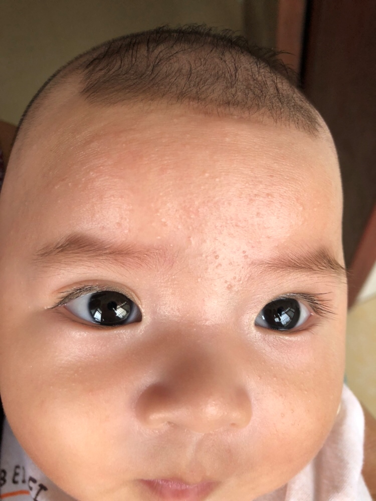 有谁知道宝宝长这个是什么东西，热了就红和痒，不热就不痒也不红，远看没什么看不出来长了，近看就很明显一粒粒的，摸起来刮手的，可以挤出来米色小米粒，半夜好痒宝宝老是抓