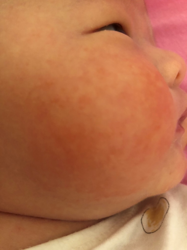 心烦 都长这了一段时间 是痱子还是湿疹呢？快点好呀！