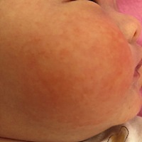 心烦 都长这了一段时间 是痱子还是湿疹呢？快点好呀！