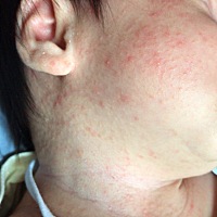 宝宝脸上脖子上长了好多这个红点点 这是湿疹还是痱子啊 擦了婴宝不管用 每天晚上都是用金银花煮水洗澡 ...