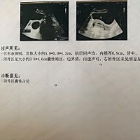 连续七天测排卵都是强阳，一直没有转弱，后来又用早孕试纸测发现有两条杠了，就去医院做b超，结果如下了...