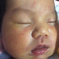 刚出生7天的宝宝 ，脸上好多这种小红疹子 ！有没有有经验的宝妈知道这是什么引起的吗？