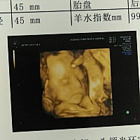 今天去做四维彩超一次性过