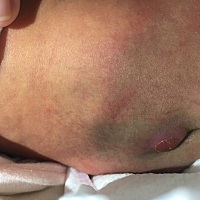 刚换尿裤突然发现宝宝屁股后面这样了，有遇到这种情况的宝妈吗？现在晚上来不及去医院检查