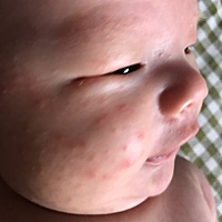 这到底是湿疹还是痱子？身上一处都没有，全长脸上🐳这怎么办啊