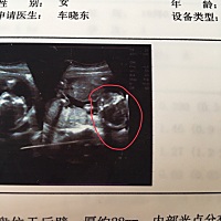 今天b超，这是拍到宝宝脸了吗