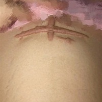 刀疤这样能生二胎吗？大宝男孩再过几天就两岁了，二胎现在怀孕3个月，我的刀疤是疤痕性的，两年的还...