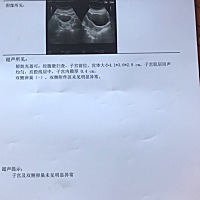 子宫内膜薄得有没有   怎么来治疗呢…… 急急急………