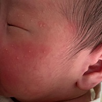 急！宝宝21天脸长红块和一粒粒该怎么办？