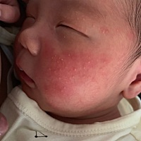 宝宝21天脸长红块和白点怎么办，急