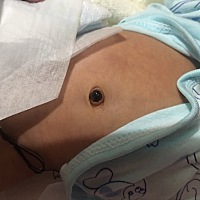 今天发现宝宝肚脐这样，好担心，昨天还好好的