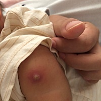 宝妈们知道这个白点正常吗？刚生下来的时候打预防针的地方，你们的宝宝也这样的吗？