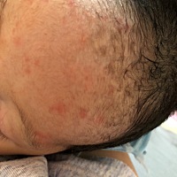 湿疹抹什么药膏都好不了 反反复复 怎办啊？