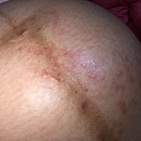 前天晚上回到婆婆家住，不知道是因为床被太潮还是啥过敏，突然肚子好痒又不敢抓，一看肚子长好多红...