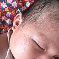 是湿疹吗？还是给热到了！求助