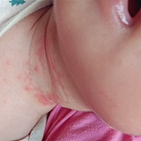 宝宝脖子长了好多这个，一直不好，大家有什么好办法？