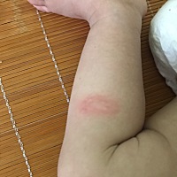 这是寻麻疹吗？昨晚长了涂了青草药膏一会消了继续长，早上又有，有什么办法吗？