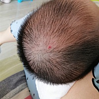 大家有知道这是什么吗？宝宝头上长个红点，刚出生一点点，最近发现变大了一点