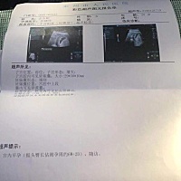 看孕囊准不准，谁会看男女的